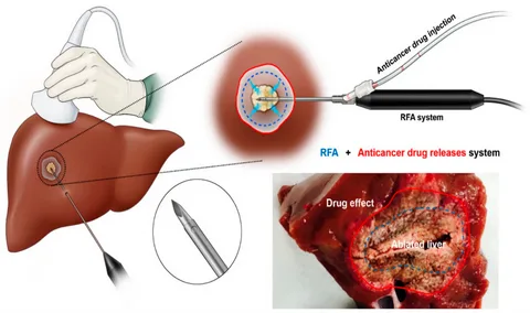 The Role of Ablation Therapy in Modern Cancer Care