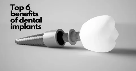 The Everyday Reality of Dental Implants